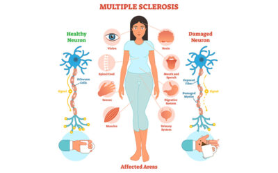 Multipel skleros (MS) – orsaker symptom naturliga stödstrategier