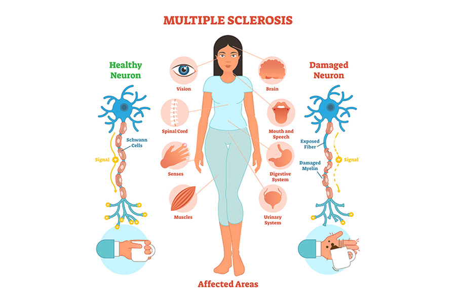 Multipel skleros (MS) – orsaker symptom naturliga stödstrategier
